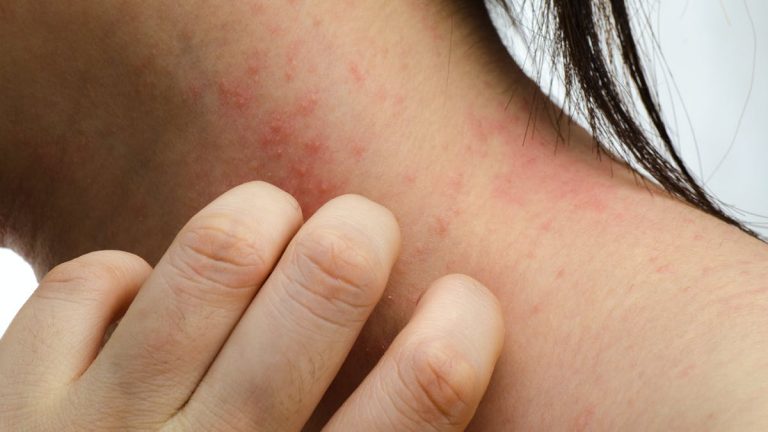 cellulite infectieuse visage