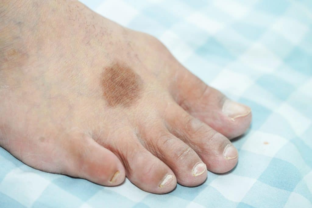 Dermite ocre au pied