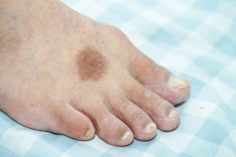 Dermite ocre au pied