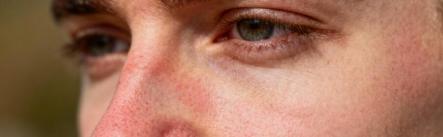 Visage montrant des rougeurs et des squames typiques de la dermite séborrhéique au niveau des ailes du nez et des sourcils