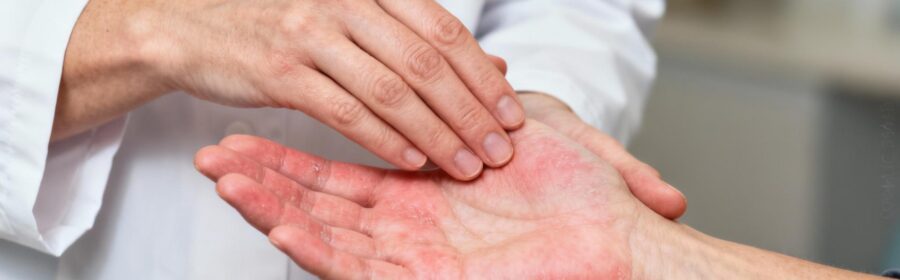 Dermatologue caucasien examinant attentivement les mains d'un patient présentant une légère rougeur et sécheresse cutanée